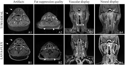 The application value of LAVA-flex sequences in enhanced MRI scans of nasopharyngeal carcinoma: comparison with T1WI-IDEAL